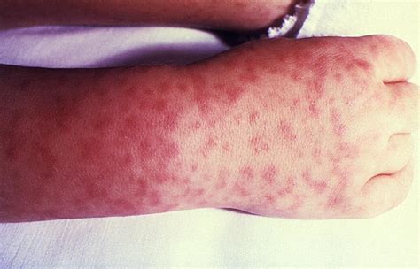 Spotted fever .